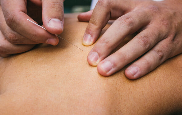 ClientRecevingAcupunctureServices1 1